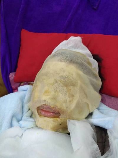 赫莲娜护理引发的脸部烧伤事件，惊人事件震惊众人！