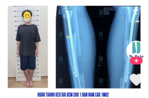 品牌老板直播喊话顾客断骨增高，揭秘增高真相，健康风险需警惕